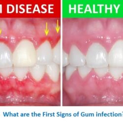 Gum