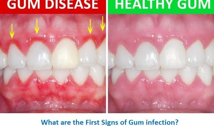 Gum