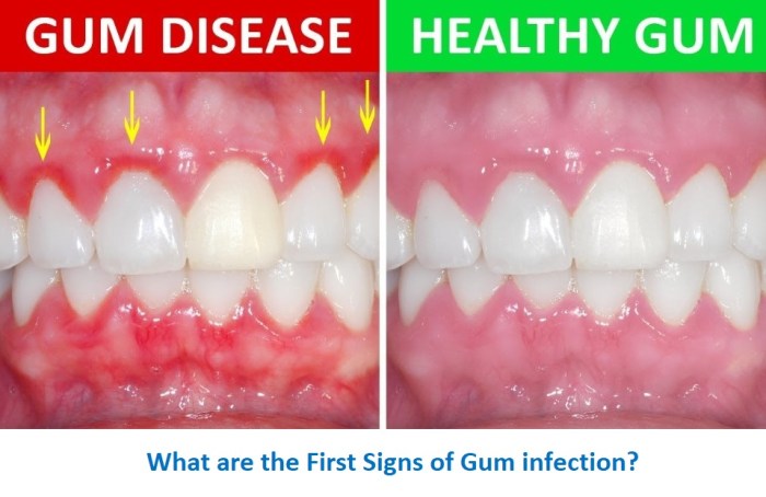 Gum